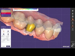 A real time single tooth crown design in exocad