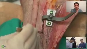 Multi-directional Tibial Tubercle Transfer (MD3T)