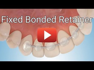 Fixed Bonded Retainer