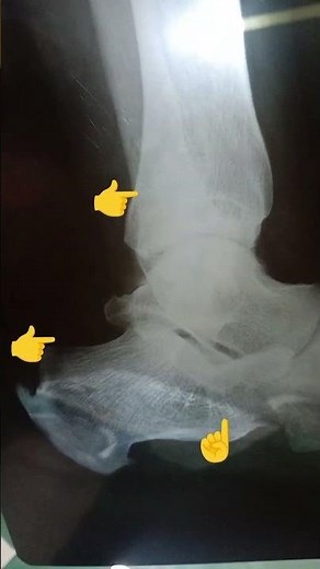 Xray foot / bone spurs / calcanium