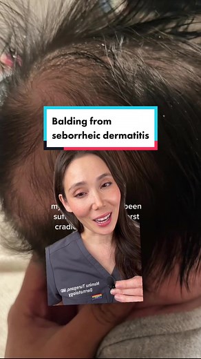 Understanding Seborrheic Dermatitis: Causes, Symptoms, and Treatments