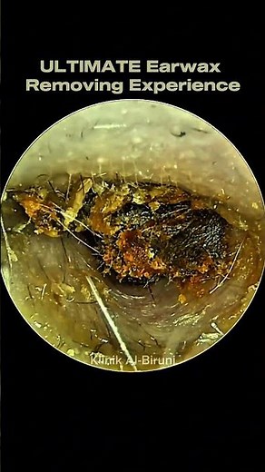ULTIMATE Earwax Removing Experience