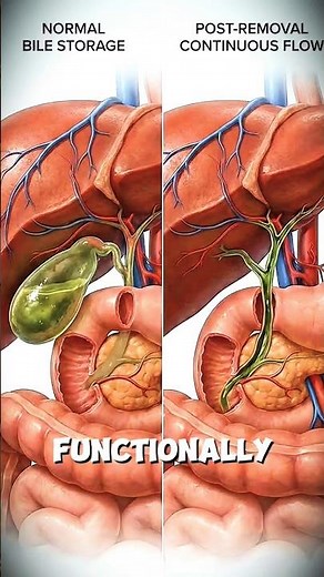 What Happens If Your Gallbladder Is Removed | No Gallbladder Can You Live Normally | Life Without It