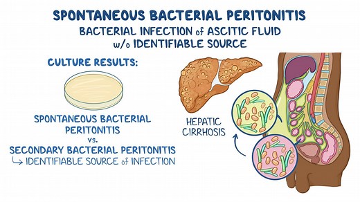 Video: Spontaneous bacterial peritonitis: Clinical sciences - Video Explanation! | Osmosis | Osmosis