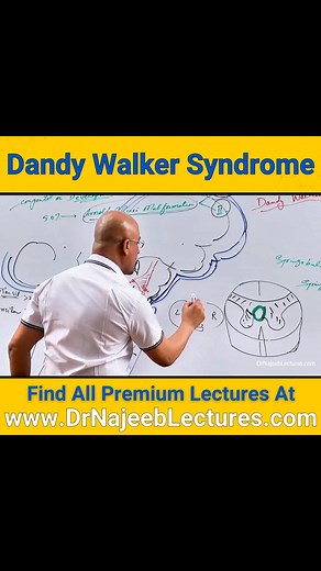 8.8K views · 275 reactions | Dandy Walker Syndrome. Dandy-Walker Syndrome (DWS), also known as Dandy-Walker malformation, is a rare congenital brain malformation characterized by abnormalities in the cerebellum and surrounding structures. | Dr. Najeeb | Facebook