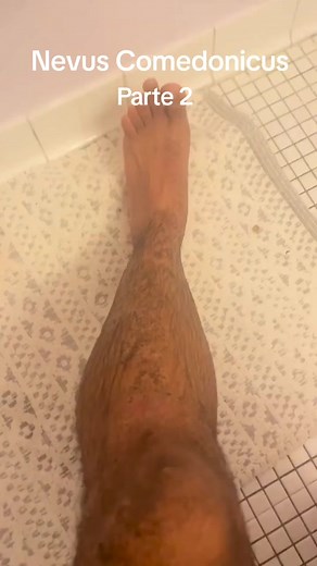 #blackheadsextractions #blackheadsremoval #extractionsatisfaciton | nevus comedenicus removal que es