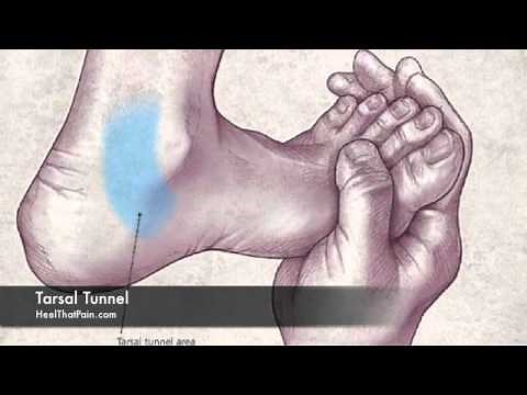 Tarsal Tunnel - Nerve Entrapment of the Foot