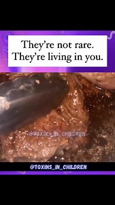 🪱MEAT INFESTED WITH PARASITES.. That thing you’ve been feeling lately The bloat that won’t go away. The cravings that hit hard. The brain fog you keep blaming on poor sleep. The anxiety, mood swings, constipation, itching, gas, weird stools, skin flares, dark circles under your child’s eyes… They’re not “random.” And they’re not “just how you are.” Parasites are real. They’re not just in third-world countries. They’re not just in dramatic Facebook stories. This one? Was found on an endoscopy. I