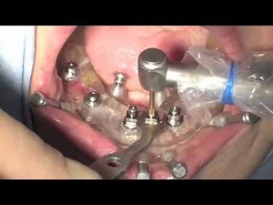 Dental Implant Surgery: Teeth in a Day Branemark system Nobel biocare