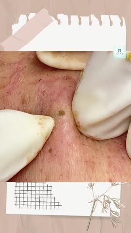 Big Cystic Acne Blackheads Extraction Blackheads & Milia, Whiteheads Removal Pimple Popping #shorts