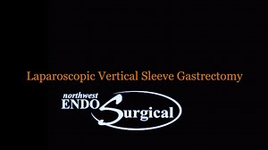 Gastric Sleeve Surgery