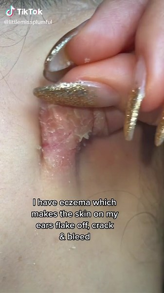 I am sick of waking up with the skin on my ears literally hanging on for dear life because of my #eczema 😩 #eczemaears #eczemaearlobes #eczemarash #eczemaflareup #sheddingskin #skinpeeling #peelingskin #itchyskin #flakingskin #flakeyskin #eczematok #eczemaflareup #eczemalife #eczemawarrior #eczemaawareness #eczemacommunity #eczemasufferers #eczemahealing #eczemaface