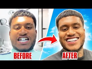Is it a GOOD IDEA to get your teeth done in TURKEY? (TEETH TRANSFORMATION)
