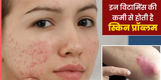 इन 4 विटामिन्स की कमी बन सकती है त्वचा रोगों का कारण, डॉक्टर से जानें कैसे हैं ये त्वचा के लिए फायदेमंद