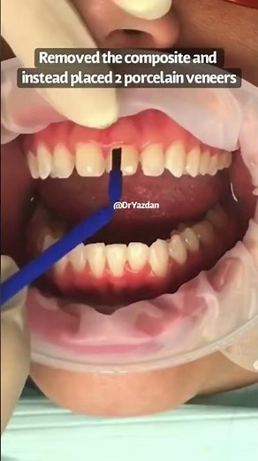 Porcelain veneers two front teeth before and after | porcelain veneer process | Dr. Yazdan OC