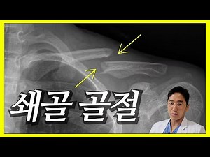 쇄골 골절의 치료 - fracture of clavicle