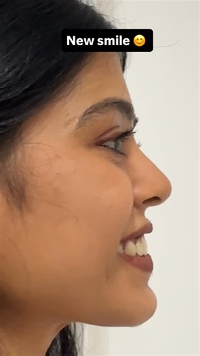 Kirubaharan Selvakumar | Smile transformation for Open bite with Invisalign @opal_dentistry by @dr.kirubaharan For appointments 📞+91 8438237665 Branches :... | Instagram