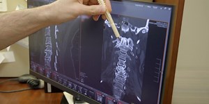 YOUR HEALTH: First in the US: MySpine Cervical Fusion