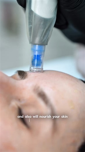 MedSpa | NY on Instagram: "💉Meso needling is a targeted microneedling technique that creates controlled microchannels in the skin while delivering active serums directly where they are needed most. 🧪When paired with Toskanimed serums, it becomes a powerful method for improving acne scars and overall skin quality. How it works • Fine needles stimulate the skin’s natural repair response • Microchannels allow active ingredients to penetrate deeper • Collagen and elastin production increases over