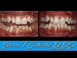 Scaling and Root Planing • Video • MEDtube.net