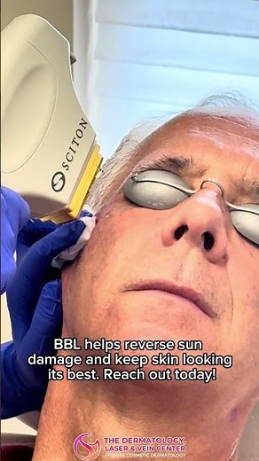 How Men Treat Age Spots | Laser Removal Explained #cincinnati #cosmeticdermatology