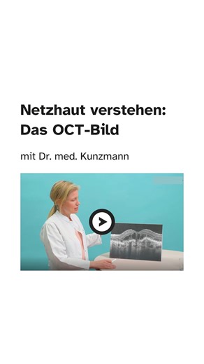 Wie erkennt man Flüssigkeit in der Netzhaut bei Erkrankungen wie feuchter AMD, DMÖ oder RVV? In diesem Reel zeigt Dr. Berenike Kunzmann wie Flüssigkeitseinlagerungen durch ein OCT-Bild im Vergleich zu einer gesunden Netzhaut erkennbar werden und warum das so wichtig für die Diagnose und Behandlung von Netzhauterkrankungen ist. Hast du das gewusst? Oder möchtest du mehr darüber wissen? Stelle deine Fragen in den Kommentaren! #DMÖAugenblicke #nAMDAugenblicke #RVVAugenblicke #AugenblickeRoche #Opht