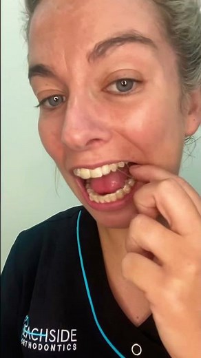 How to place elastics on aligners with cut outs (Class 2)