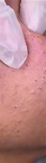 #pimple #cystremoval #extration