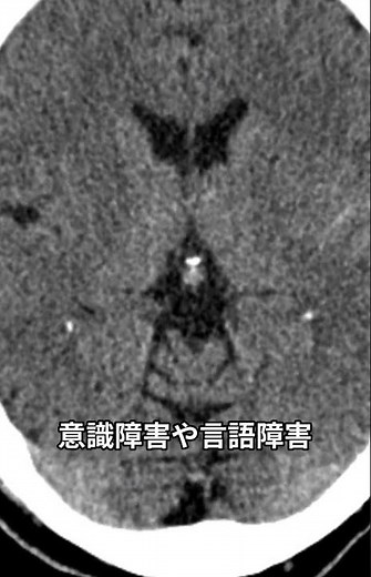 40秒でわかる脳出血