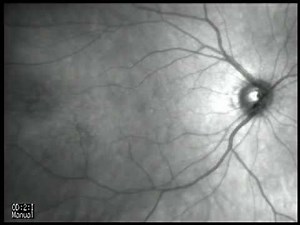 Eye Floaters Video 2