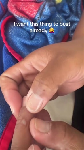 1.6K views | 195K views · 586 reactions ｜ How do I bust this burn pimple ？ I can feel the puss !! #pimplepopperaddict ｜ Sirius Rydstorm New Hope New Goal 2K25  | Giant Monster | Facebook