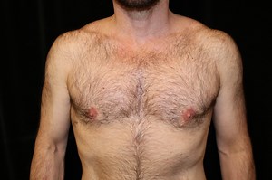 Male Breast Reduction Surgery