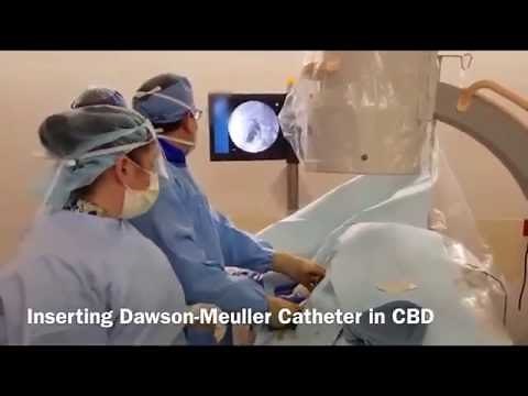 Percutaneous Biliary Metallic Stent Placement