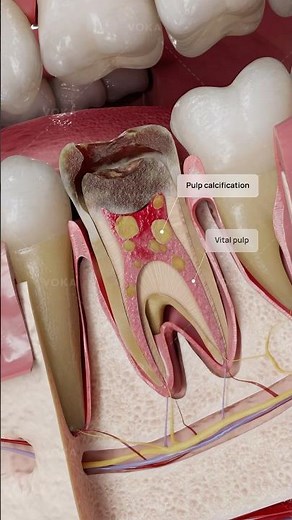What is pulp calcification and how does it affect tooth health? Explained with a 3D visualization