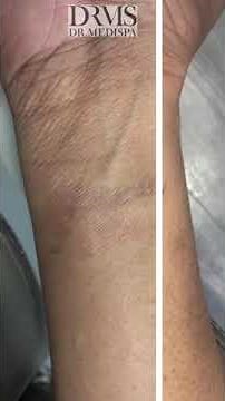 Tattoo removal with Q-switched lasers | DRMEDISPA