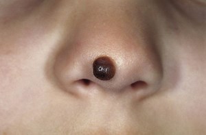 Congenital melanocytic nevus - Alchetron, the free social encyclopedia