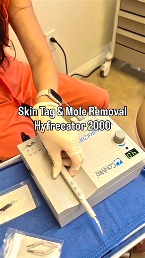 MILK MEDISPA | Skin Tag & Mole Removal with the Hyfrecator 2000 We use the Hyfrecator 2000, a trusted medical device that removes skin tags and benign... | Instagram