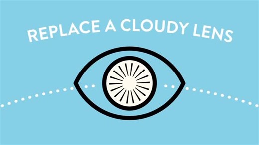 The Light Adjustable Lens is the only intraocular lens (IOL) that is fully adjustable after cataract surgery. The LAL allows you to have the unique opportunity to adjust your vision based on your personal desires and lifestyle. Call us to schedule an appointment for more information! | Huffman & Huffman, PSC | Facebook