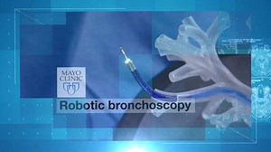 3.6K views · 92 reactions | Robotic bronchoscopy uses flexible robotics that enable new possibilities and tools that allow physicians to visualize and biopsy remote parts of the lung that were previously inaccessible. Watch to learn what this means for diagnosing lung cancer. To learn more about lung cancer, visit: https://mayocl.in/34cQteY | Mayo Clinic | Facebook