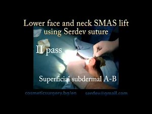 Lower face and neck SMAS lift - Serdev suture. Technique - serdev@gmail.com.