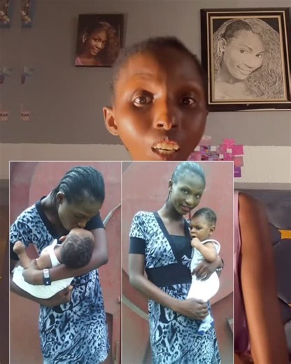 Onitsha Emortungh on Instagram: "It’s Scleroderma awareness month June🤍 I’m Violetemor Nicholas Onitsha, I’ve been struggling with Scleroderma for since 2014😔 Scleroderma is an autoimmune chronic illness that affects the whole body,connective tissues, internal organs and can also disable the affected person😔 Scleroderma used to be rare then but for now I think it’s no longer rare😔 There r different types of Scleroderma and it affects the patients differently. Scle