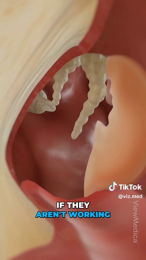 Understanding Tympanomastoidectomy for Ear Health