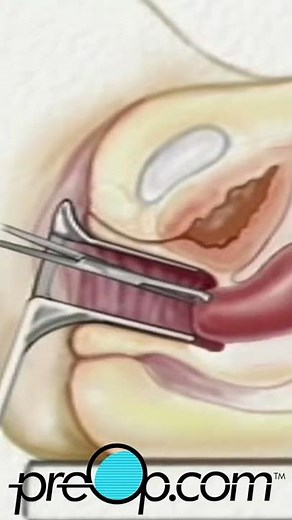 Dilation and Curettage D & C Surgery | PreOp® Patient Engagement and Education #shorts