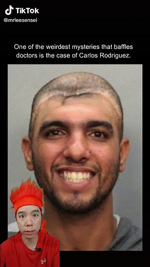 Sobrevivir con la mitad de una cabeza: Un caso increíble