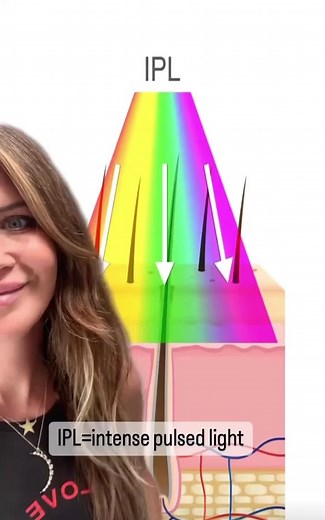 Laser Treatment for Hyperpigmentation: What You Need to Know!