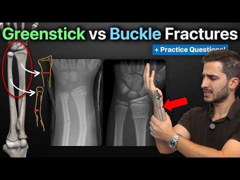 Greenstick and Buckle (Torus) Fractures: Explained! + Practice Qs | Everything You Need to Know