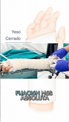 ¿Qué tipo de inmovilización necesitas para una fractura de muñeca o mano? Férulas y yesos explicados