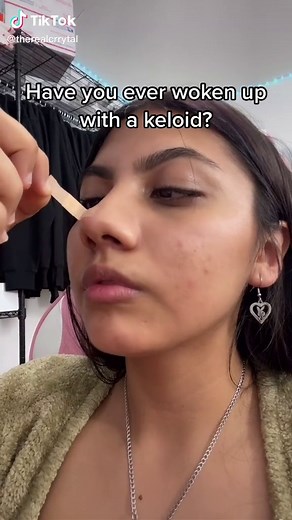 Effective Keloid Removal Cream and Treatment Methods