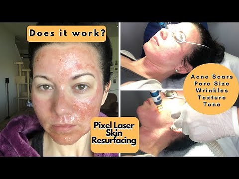 Pixel Laser Treatment For Acne Scars & Big Pores