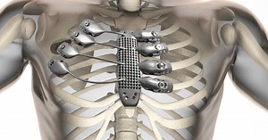 Patient receives 3D-printed titanium sternum and rib cage